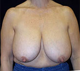 Patient # 47276 Before Photo # 1
