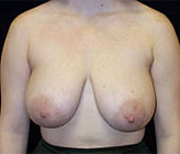 Patient # 17588 Before Photo # 1