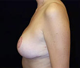 Patient # 33756 After Photo # 2