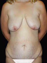 Patient # 72789 Before Photo # 1