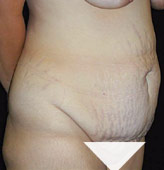 Patient # 72789 Before Photo # 3