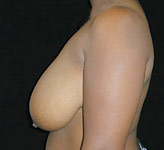 Patient # 56628 Before Photo # 1