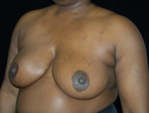 Patient # 36517 After Photo # 2