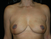 Patient # 67992 After Photo # 2