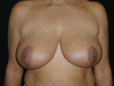Patient # 67992 Before Photo # 1