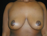 Patient # 48365 After Photo # 2