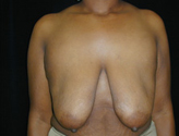 Patient # 48365 Before Photo # 1