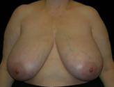 Patient # 96694 Before Photo # 1