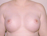 Patient # 59817 After Photo # 2