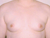 Patient # 59817 Before Photo # 1