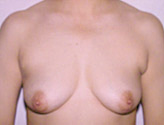 Patient # 70745 Before Photo # 1