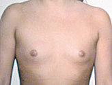 Patient # 41429 Before Photo # 1