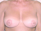 Patient # 29556 After Photo # 2