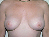 Patient # 77396 After Photo # 2
