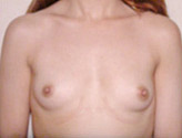 Patient # 21351 Before Photo # 1