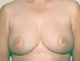 Patient # 69698 After Photo # 2