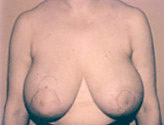 Patient # 69698 Before Photo # 1