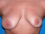 Patient # 39520 Before Photo # 1
