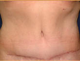 Patient # 72804 After Photo # 2