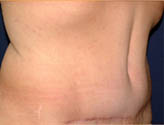Patient # 72804 After Photo # 4
