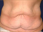 Patient # 72804 Before Photo # 1