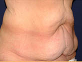 Patient # 72804 Before Photo # 3