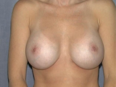 Patient # 22741 After Photo # 2