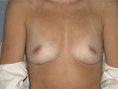 Patient # 22741 Before Photo # 1