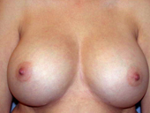 Patient # 12310 After Photo # 2
