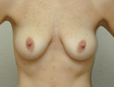 Patient # 82948 Before Photo # 1