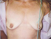 Patient # 73635 Before Photo # 1
