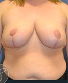 Patient # 38428 After Photo # 2
