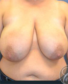 Patient # 38428 Before Photo # 1
