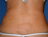 Patient # 24141 After Photo # 2