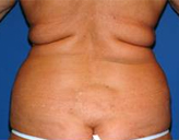 Patient # 24141 Before Photo # 1