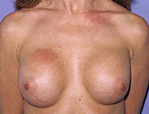 Patient # 26915 After Photo # 2