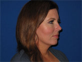 Patient # 21685 After Photo # 2