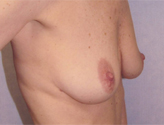 Patient # 23115 Before Photo # 3