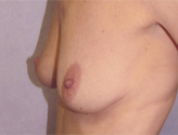 Patient # 23115 Before Photo # 5