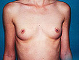 Patient # 18872 Before Photo # 1