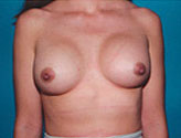Patient # 90229 After Photo # 2