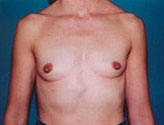 Patient # 90229 Before Photo # 1
