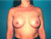 Patient # 76106 After Photo # 2