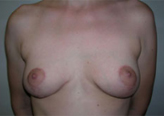 Patient # 29543 After Photo # 2