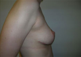 Patient # 29543 After Photo # 4
