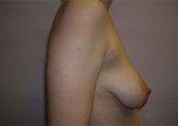 Patient # 29543 Before Photo # 3