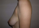 Patient # 29543 Before Photo # 5