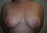 Patient # 94634 After Photo # 2