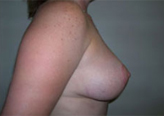 Patient # 94634 After Photo # 4