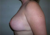 Patient # 94634 After Photo # 6
